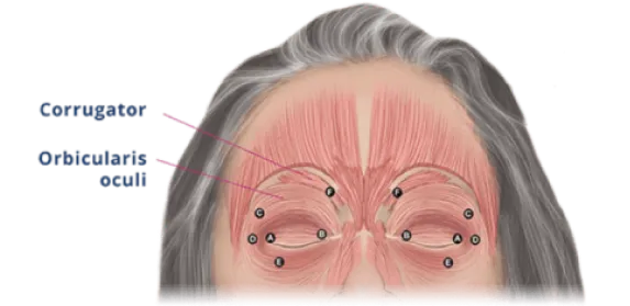 Blepharospasm Muscles Involved